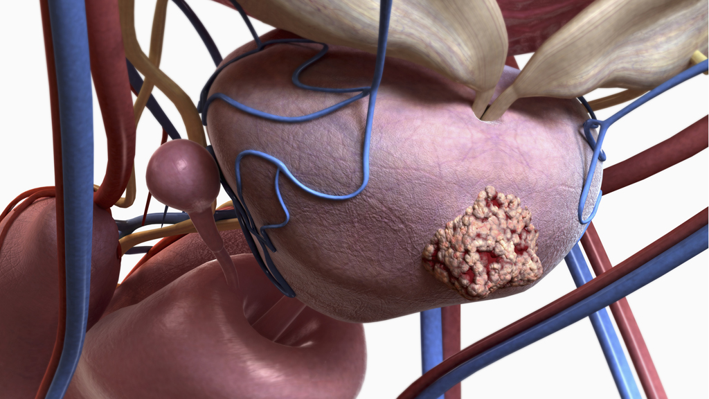 ‘Exciting’ new treatment for prostate cancer Channel 4 News