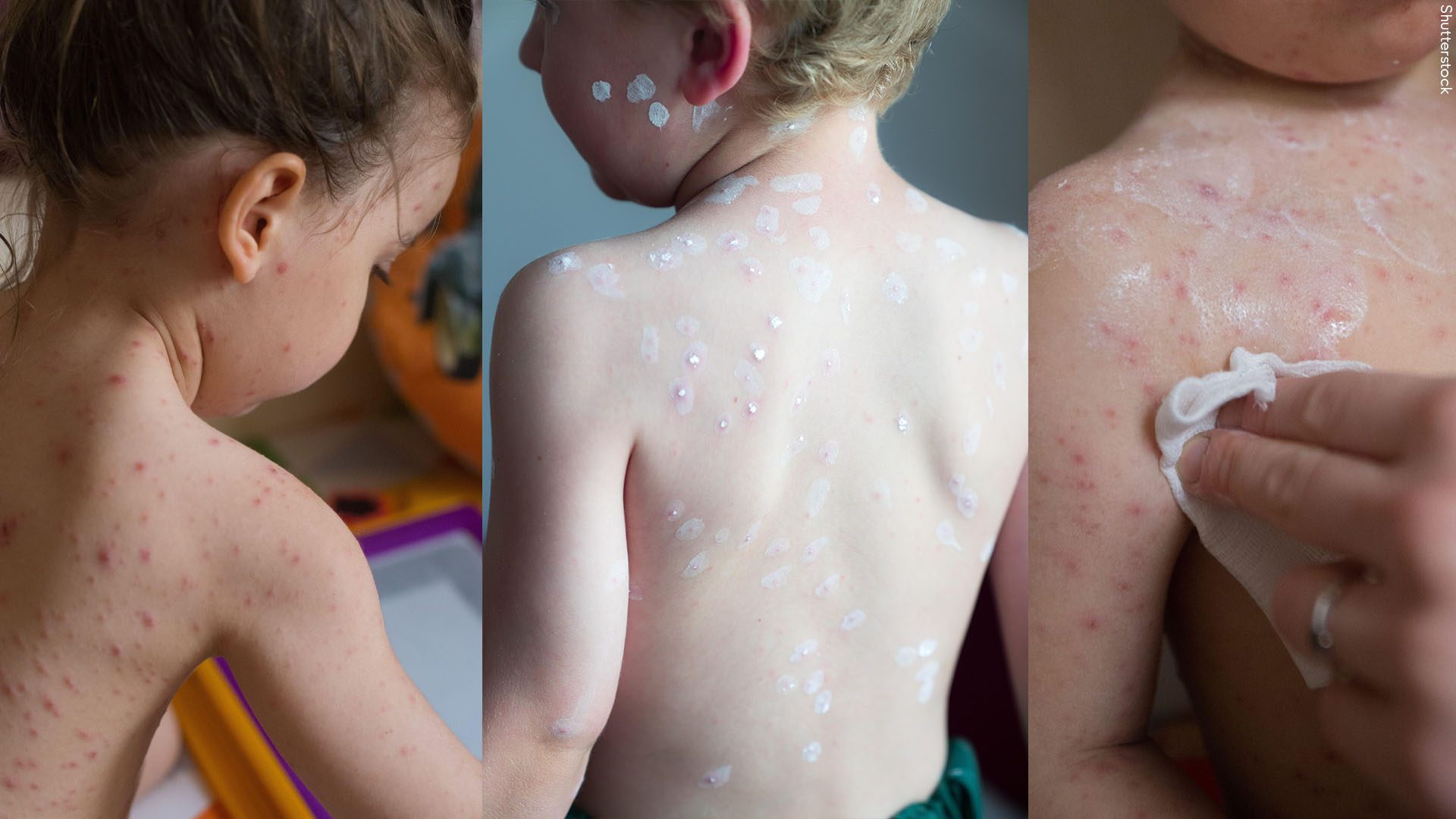 NHS to give free Chickenpox vaccine to children